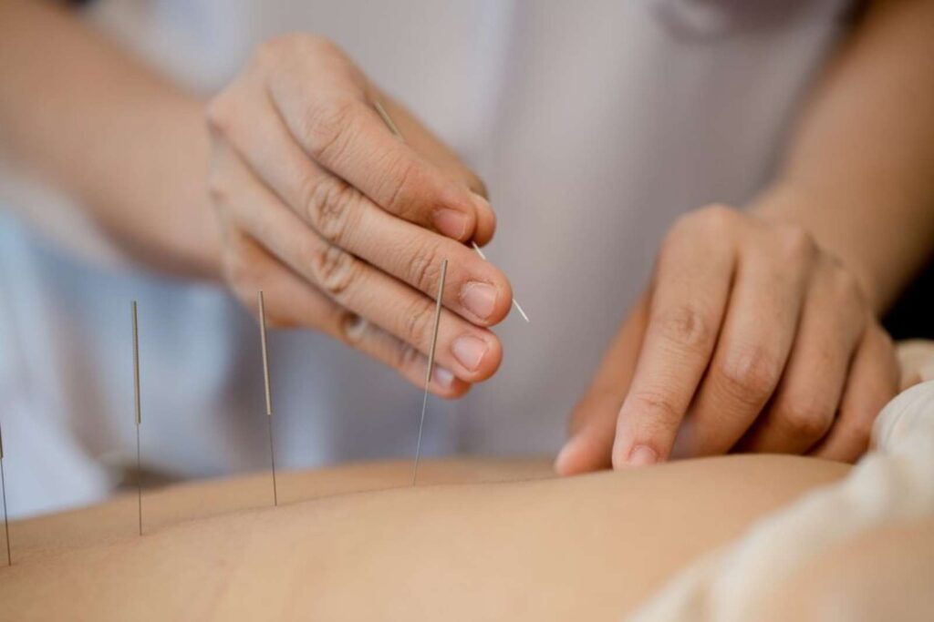 Qué es la acupuntura
